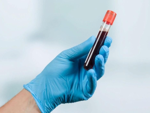 Plasma rico en plaquetas